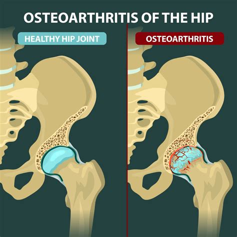 Kalça ekleminin osteoartriti ile hangi hastalık karışabilir?